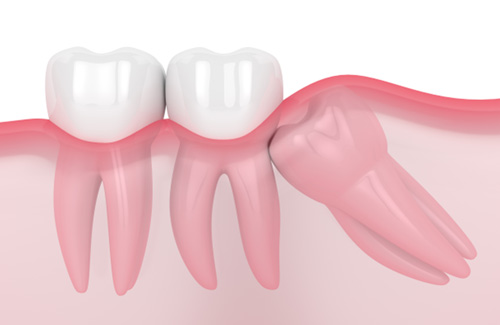 Illustration of molar growing in sideways