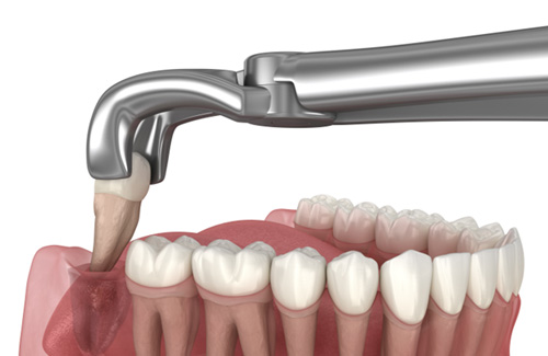 Illustration of wisdom tooth extraction