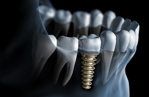 Digital illustration of a dental implant