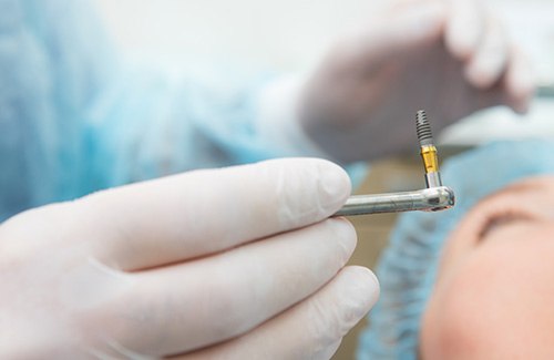 a dental implant being held by a dentist