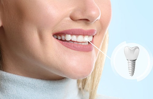 a dental implant patient showing off her smile