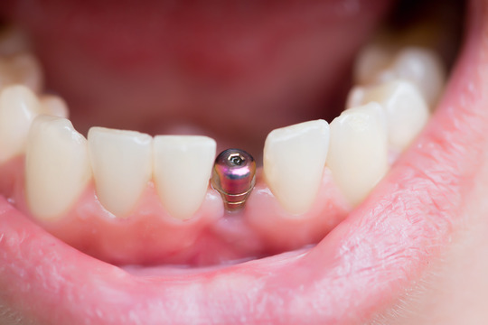 closeup of dental implant in mouth 