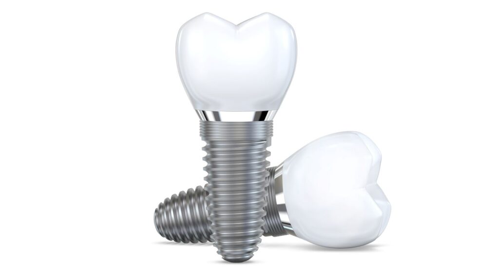 A computer-generated image of two dental implants.